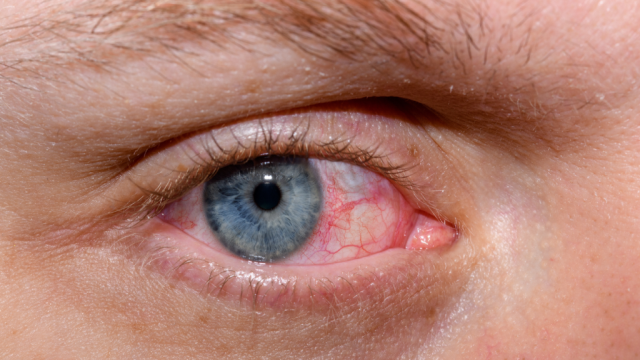 Kenali 7 Jenis Penyakit Mata yang Umum Terjadi dan Wajib Kalian Waspadai